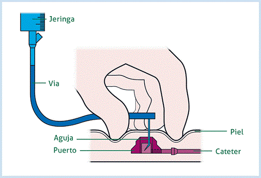 cathetertm1