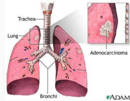 carci1