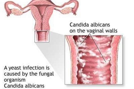 vi-sao-viem-am-dao-do-nam-candida-hay-tai-phat-1