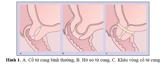 hetc1