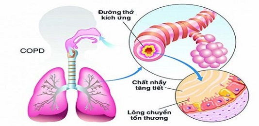 copd1