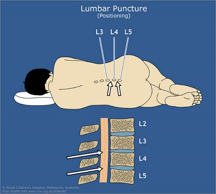 LUMBAR