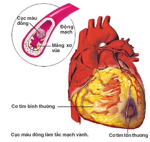 benh-mach-vanh