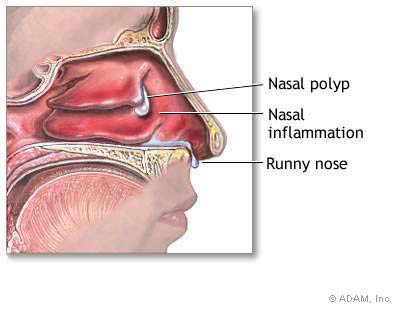 polyp_mui