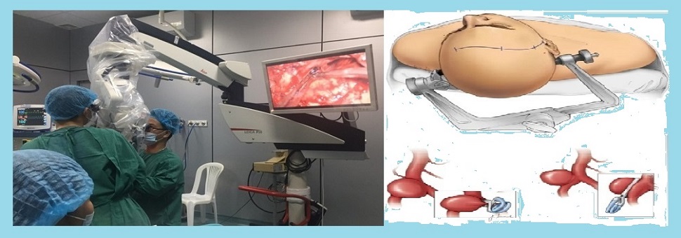 Triển khai kỹ thuật caoPhẫu thuật kẹp cổ túi phình mạch não vỡ bằng vi phẫu